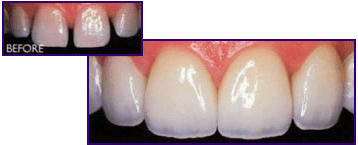 Dental Crowns Flushing NY