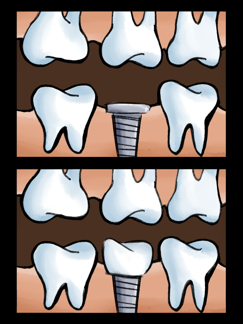 Dental Implants in Flushing NY