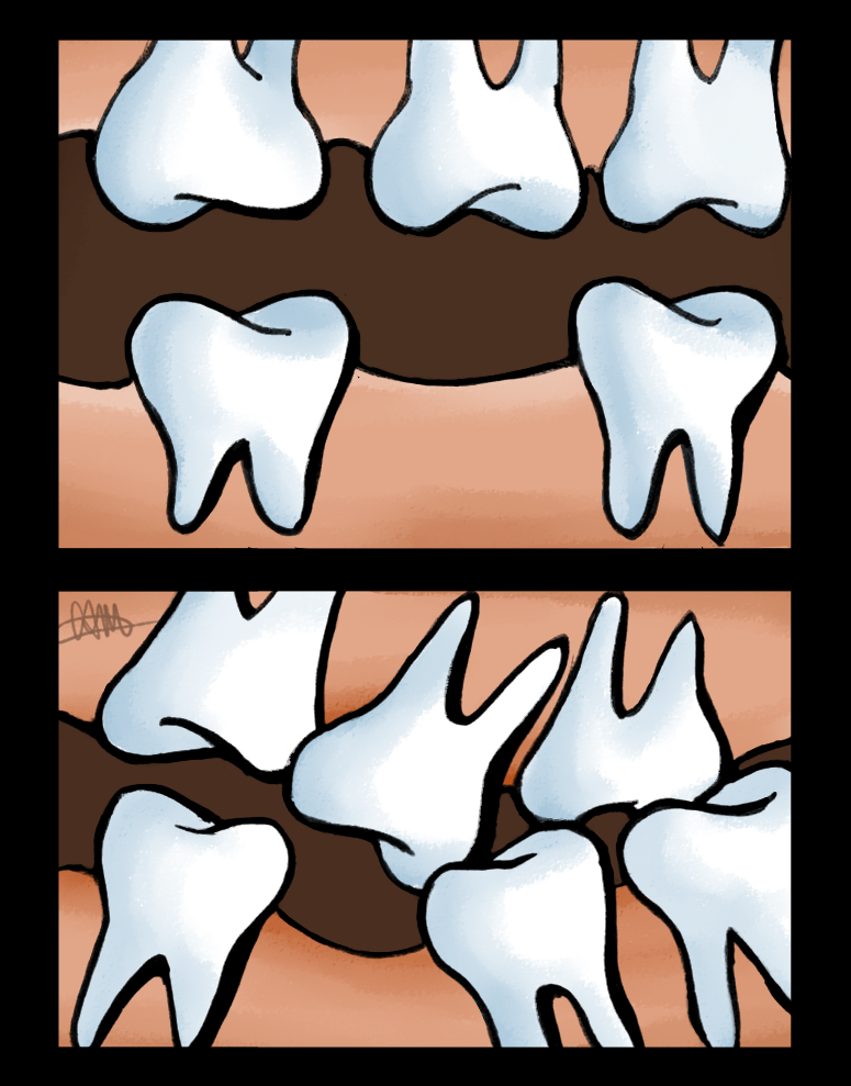 Dental Implants for Missing Teeth in Flushing NY