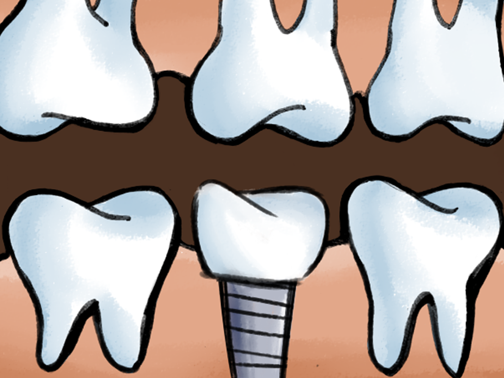 full mouth teeth implants in Flushing NY
