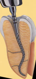 Root Canal Flushing